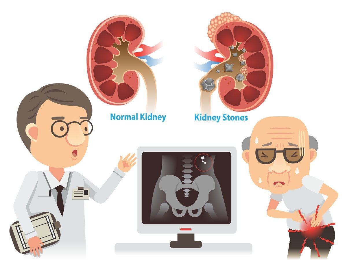 passing-a-kidney-stone-how-long-it-takes-best-health-magazine