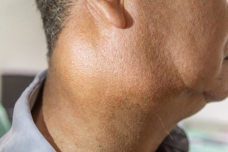 Itchy Skin Around Swollen Lymph Nodes