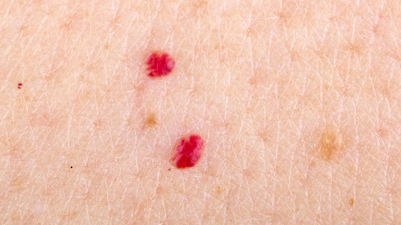 cherry angiomas