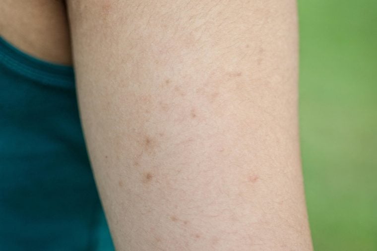 how-to-finally-get-rid-of-keratosis-pilaris-best-health-magazine