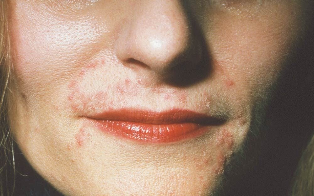 skin-conditions-that-look-like-acne-but-aren-t-best-health-canada