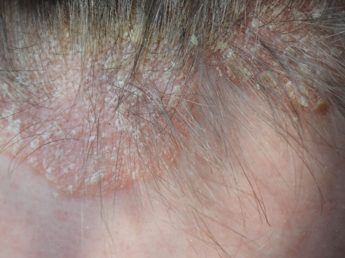 Psoriasis Bumps On Scalp