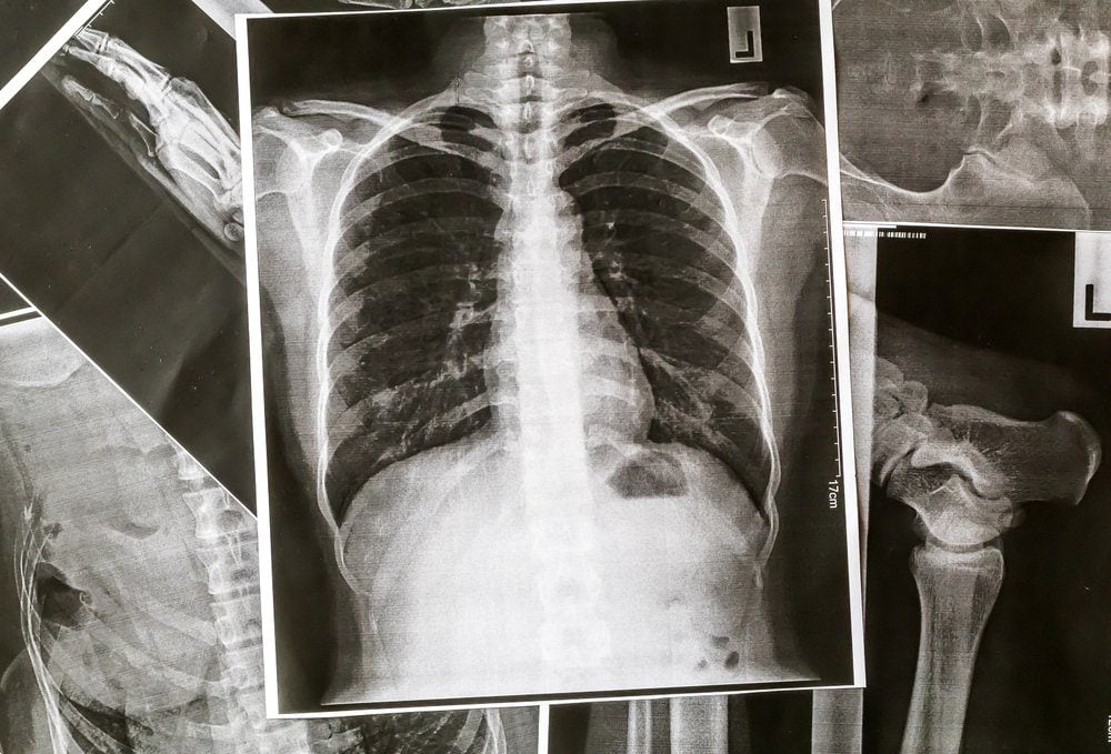 What Is A Nodule On Your Lung