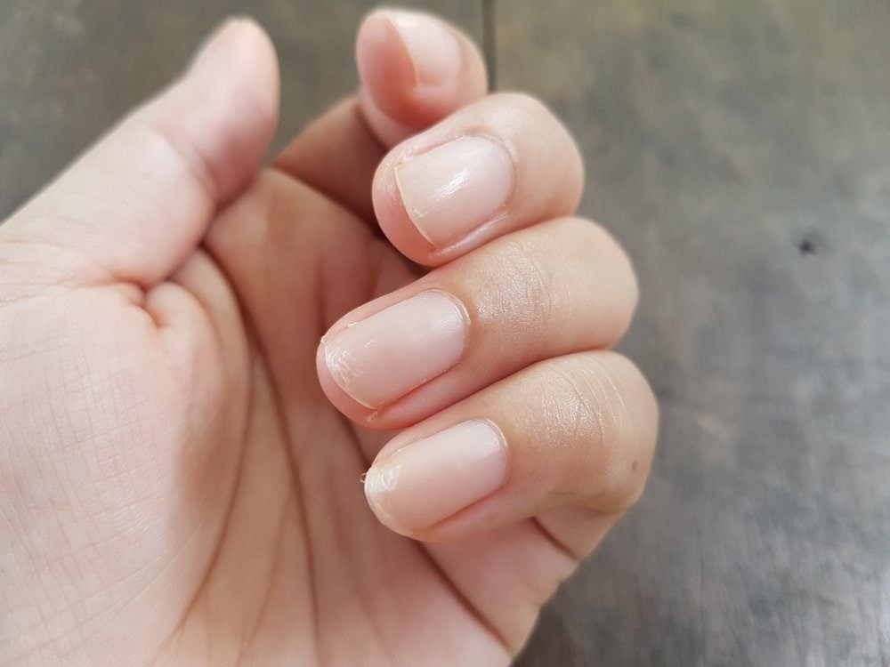 peeling-nails-what-it-could-mean-best-health-canada