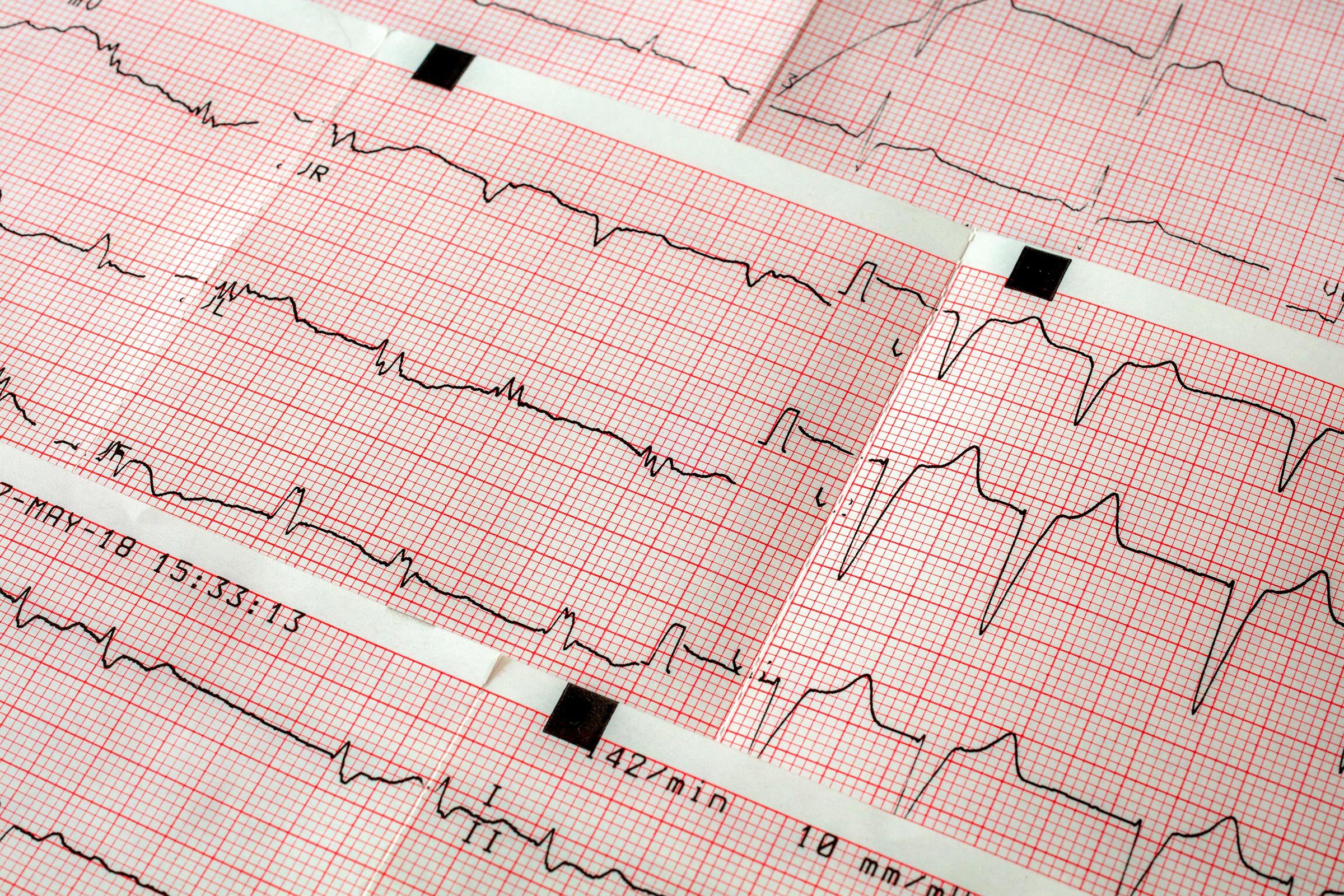 Can Heart Palpitations Be Caused By Caffeine