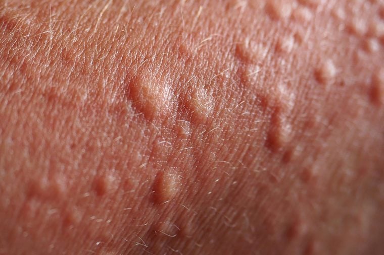 Lumps And Bumps On Skin Explained Best Health Canada