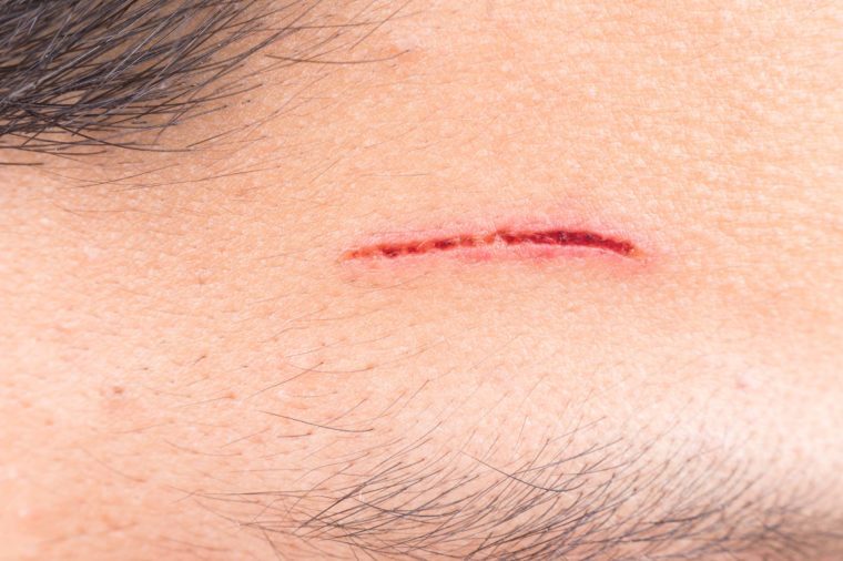 signs-of-an-infected-cut-or-scrape-you-should-never-ignore-best-health