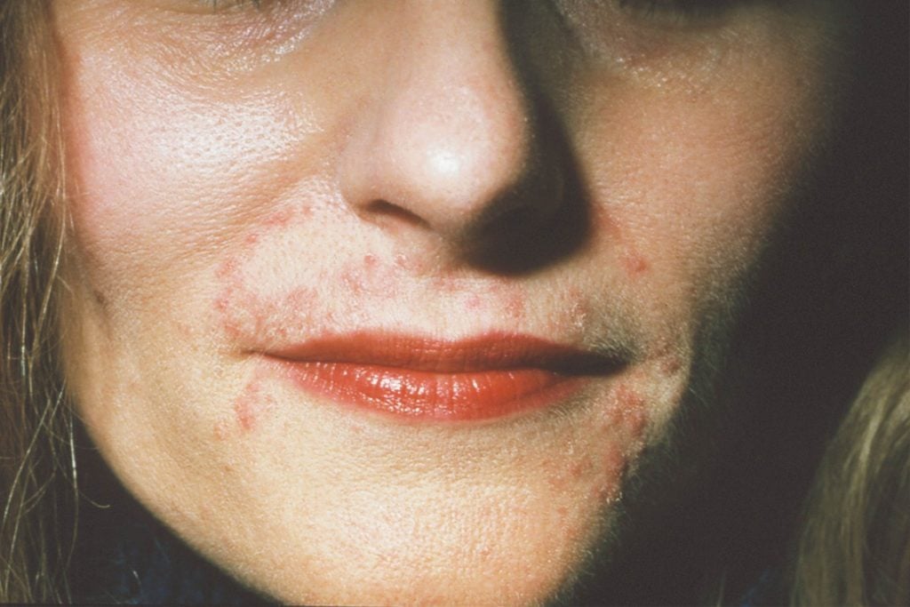 skin-conditions-that-look-like-acne-but-aren-t-best-health-canada